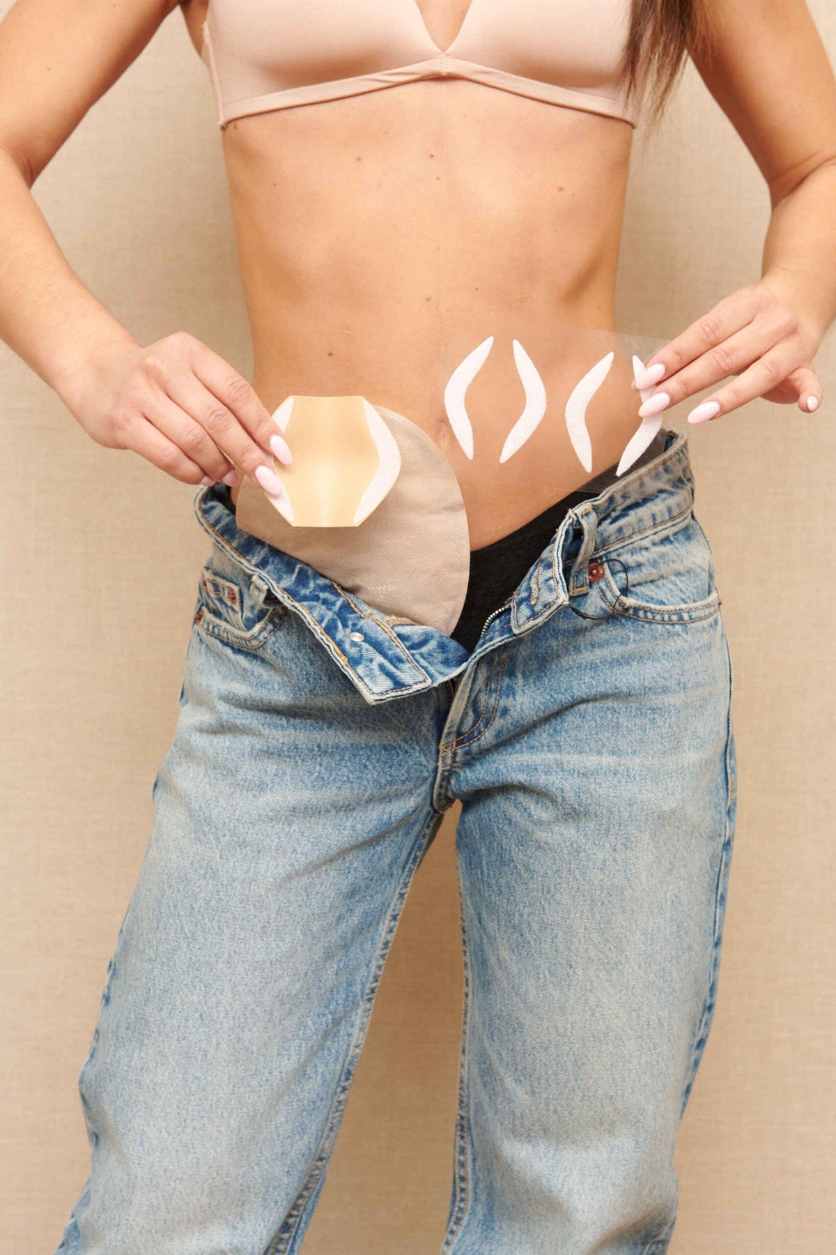 Parastomal Hernia: Complete Medical Guide